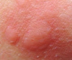 Sivrisinek ısırığı yüzünden iki bacağından oldu galerisi resim 2