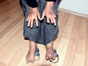 17 yıldır eşinden görmediği şiddet kalmadı, 11 parmağı kesildi