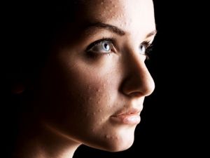 BURUN VEYA ÇEVRESİNDE SİVİLCE VARSA DİKKAT! BU HASTALIĞIN HABERCİSİ OLAB