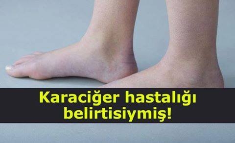 DİKKAT! SİZİN DE AYAĞINIZDA ŞİŞLİK VARSA HEMEN DOKTORA GİTMELİSİNİZ... galerisi resim 1