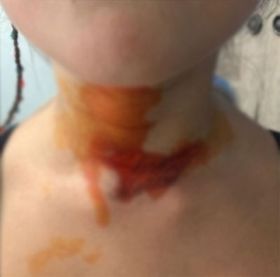 Yeliz Yeşilmen’in kızını kızgın yağ ile yaktılar!. galerisi resim 3