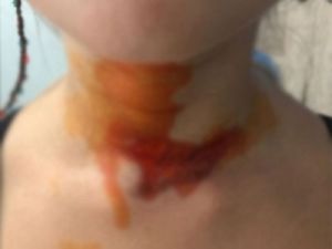 Yeliz Yeşilmen’in kızını kızgın yağ ile yaktılar!.