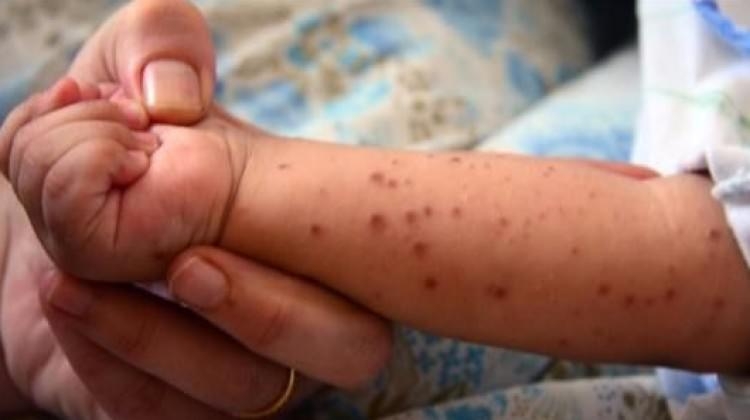 Özellikle Bebeklerde El Ayak ve Ağız Salgını Başladı galerisi resim 1