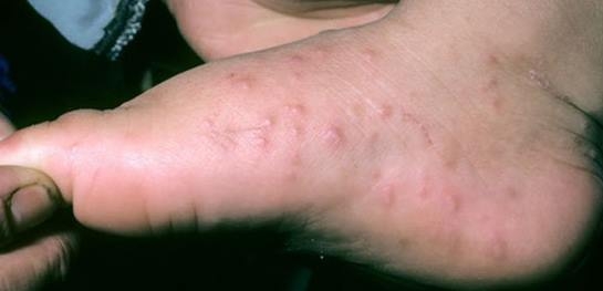 Özellikle Bebeklerde El Ayak ve Ağız Salgını Başladı galerisi resim 3