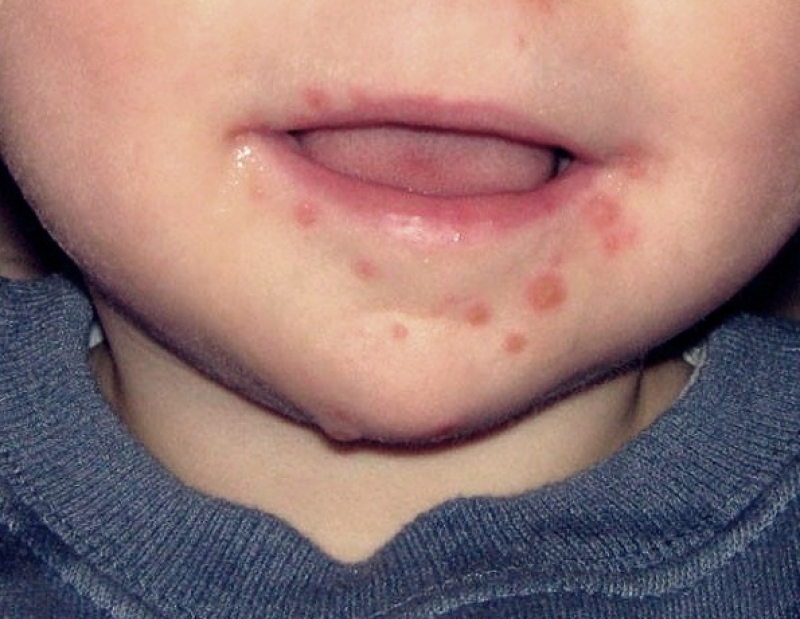 Özellikle Bebeklerde El Ayak ve Ağız Salgını Başladı galerisi resim 4