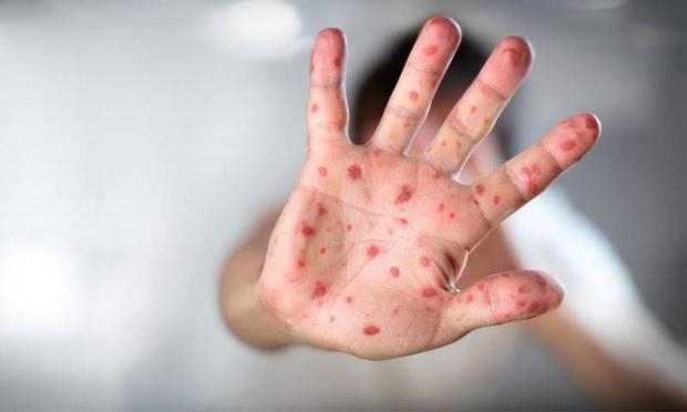 Özellikle Bebeklerde El Ayak ve Ağız Salgını Başladı galerisi resim 5