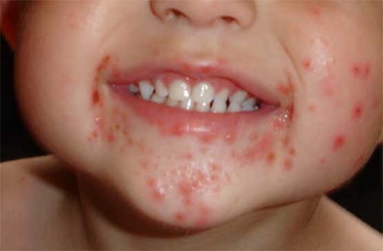 Özellikle Bebeklerde El Ayak ve Ağız Salgını Başladı galerisi resim 7