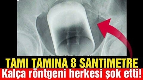 NASIL OLDU BU İŞ! ANÜSÜNDE BARDAK ÇIKTI... galerisi resim 1