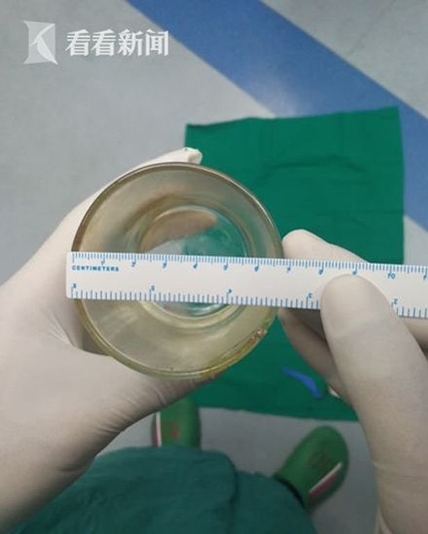 NASIL OLDU BU İŞ! ANÜSÜNDE BARDAK ÇIKTI... galerisi resim 2