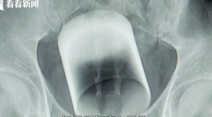 NASIL OLDU BU İŞ! ANÜSÜNDE BARDAK ÇIKTI... galerisi resim 3