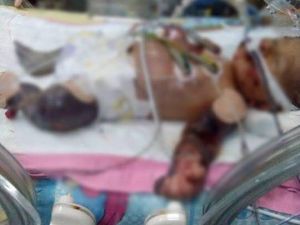 15 gün önce doğan bebek bu hale geldi!