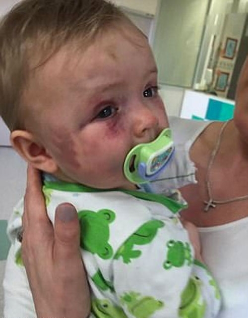 Vicdansız anne bebeğini kendi elleriyle bu hale getirdi sonrası korkunç galerisi resim 5