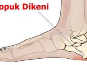 TOPUK DİKENİ SORUNUNDAN DOĞAL YOLLARLA KURTULMAK MÜMKÜN! ÜSTELİK SADECE