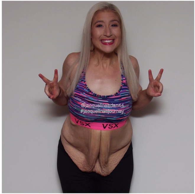 158 Kiloya İndi, Sarkan Derilerine Bakmadan Mayo Giydi galerisi resim 12