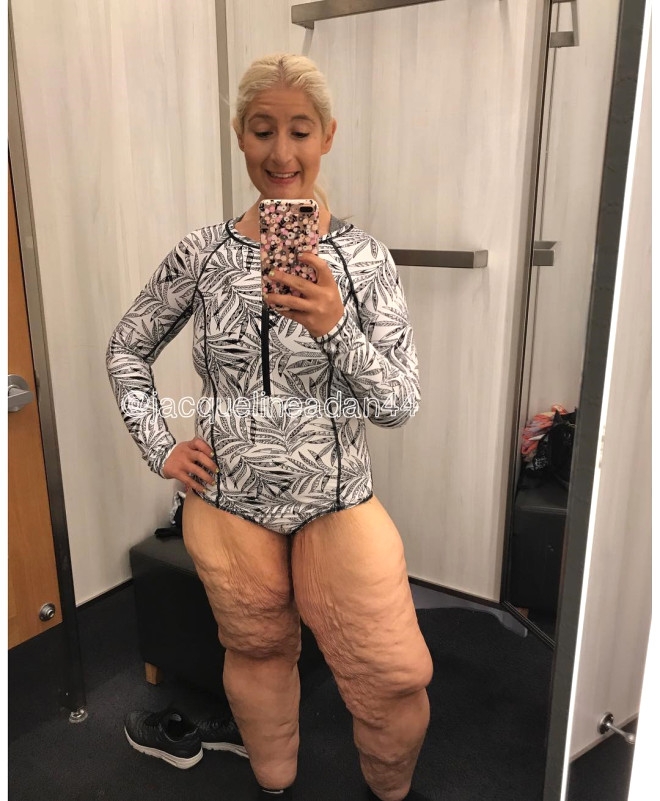 158 Kiloya İndi, Sarkan Derilerine Bakmadan Mayo Giydi galerisi resim 5