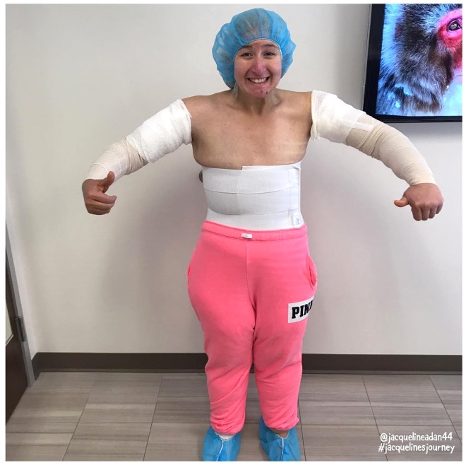 158 Kiloya İndi, Sarkan Derilerine Bakmadan Mayo Giydi galerisi resim 8