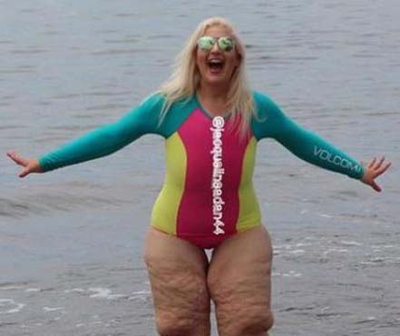 158 Kiloya İndi, Sarkan Derilerine Bakmadan Mayo Giydi galerisi resim 9