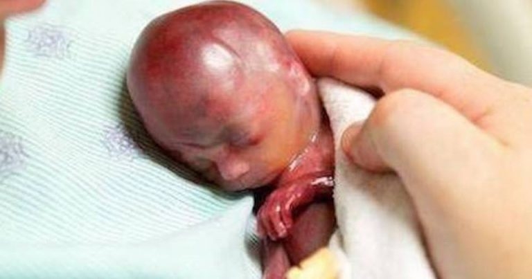 19 haftalık dünyaya geldi bebeği gören herkes şoke oldu galerisi resim 1