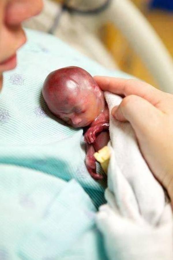 19 haftalık dünyaya geldi bebeği gören herkes şoke oldu galerisi resim 5