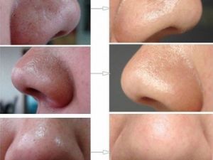 BURUNDAKİ SİYAH NOKTALARI BÖYLE KOLAYCA GEÇİRİN.. İŞTE O YÖNTEM BAKIN NA