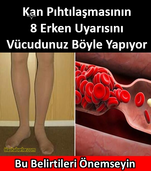 Pıhtılaşmasının 8 Erken Uyarısını Vücudunuz Böyle Yapıyor galerisi resim 1