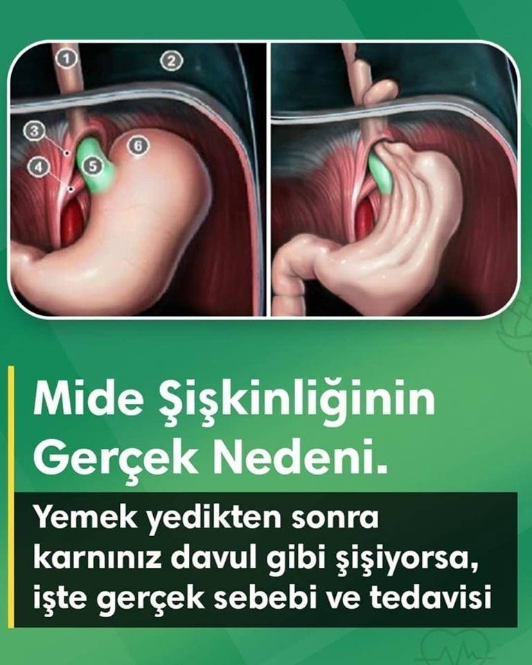 Karın şişkinliği nedir? Karın şişkinliği nedenleri ve tedavisi galerisi resim 1