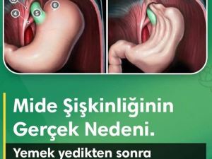 Karın şişkinliği nedir? Karın şişkinliği nedenleri ve tedavisi