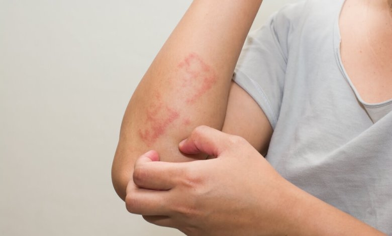 BU BESİN EGZAMA VE MANTARI ANINDA YOK EDİYOR galerisi resim 1