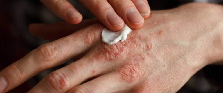 BU BESİN EGZAMA VE MANTARI ANINDA YOK EDİYOR galerisi resim 3