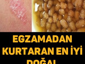 EGZAMADAN KURTARAN EN İYİ DOĞAL TEDAVİ