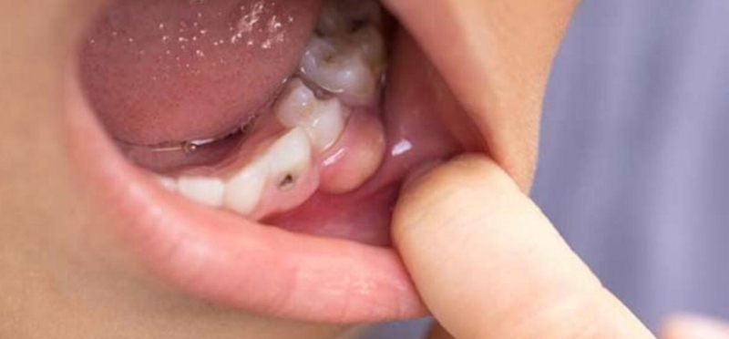 Çürük diş problemini ortadan kaldıran besin galerisi resim 11