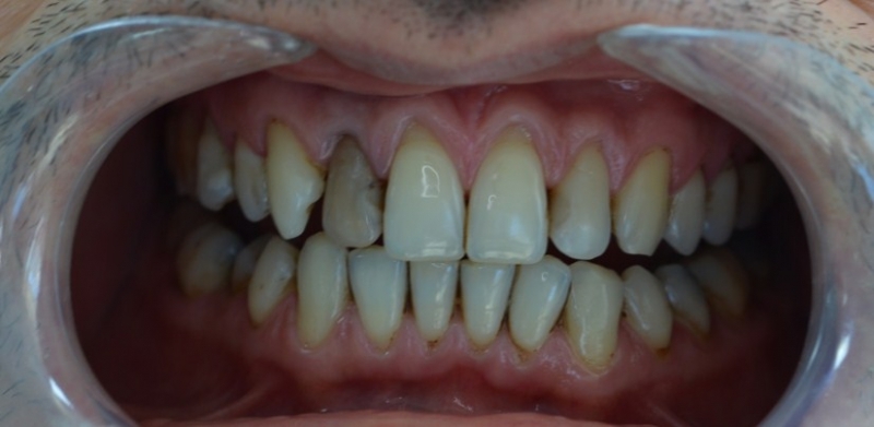 Çürük diş problemini ortadan kaldıran besin galerisi resim 2