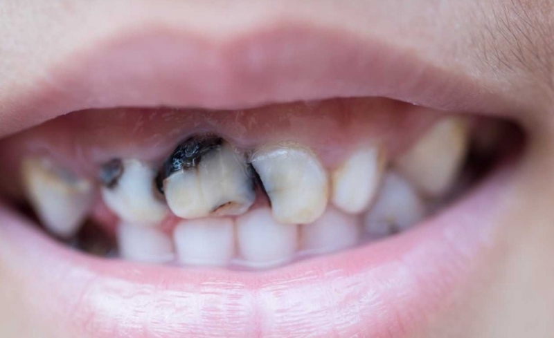 Çürük diş problemini ortadan kaldıran besin galerisi resim 3