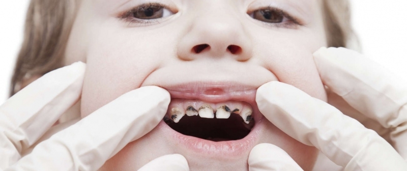 Çürük diş problemini ortadan kaldıran besin galerisi resim 6