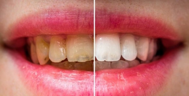 Çürük diş problemini ortadan kaldıran besin galerisi resim 7