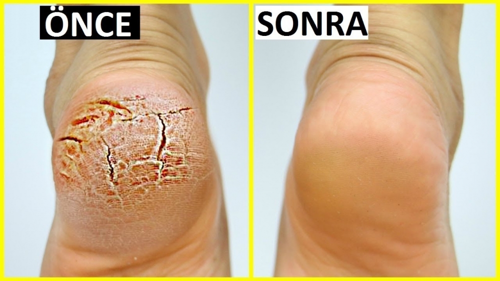 Topuk Çatlaklarını Yarım Saatte Yok Eden Çok İyi Bir Yöntem galerisi resim 1
