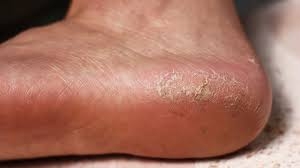 Topuk Çatlaklarını Yarım Saatte Yok Eden Çok İyi Bir Yöntem galerisi resim 2