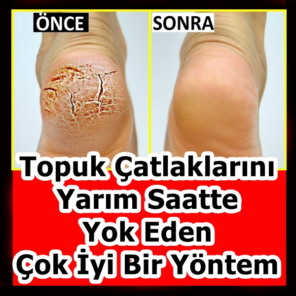 Topuk Çatlaklarını Yarım Saatte Yok Eden Çok İyi Bir Yöntem galerisi resim 4