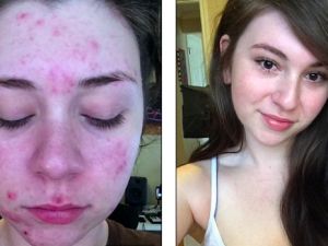 DOĞUM KONTROL HAYATINI KARARTTI...! YANLIŞ YAPMAYIN...!