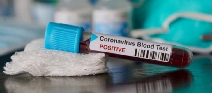 Koronavirüs'ün En Sevdiği Kan Grubu Belli Oldu galerisi resim 2