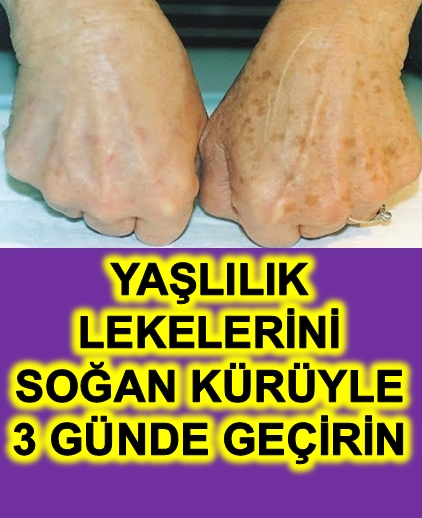 Yaşlılık Lekelerini Soğan Kürüyle 3 Günde Geçirin İşte O Tarif galerisi resim 1
