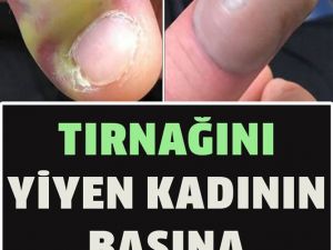 Tırnak Yiyenler Dikkat