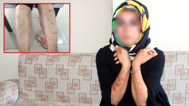 Lazer yaptırmak isterken az kalsın hayatından oluyordu galerisi resim 2