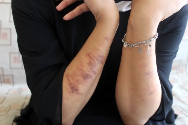 Lazer yaptırmak isterken az kalsın hayatından oluyordu galerisi resim 3