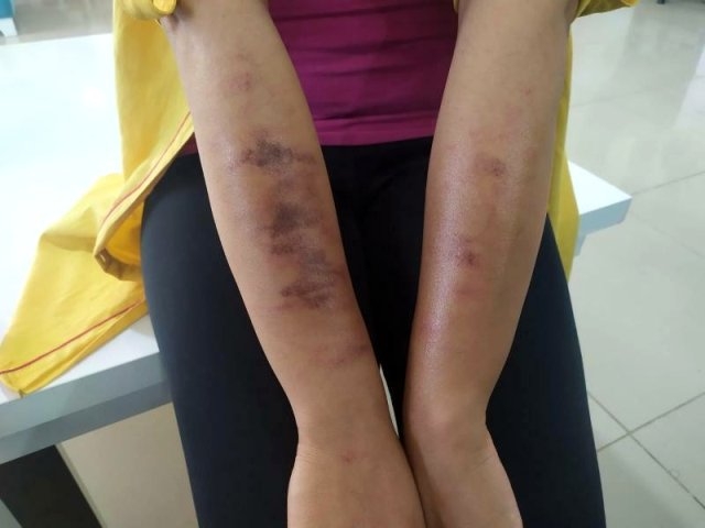 Lazer yaptırmak isterken az kalsın hayatından oluyordu galerisi resim 4