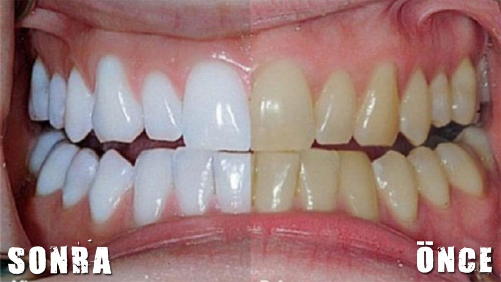 Evde 3 Dakikada Dişlerinizi Beyazlatın galerisi resim 2