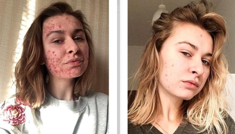 Sivilceleri yüzünden dışarı çıkamıyor Sebebi ise galerisi resim 2