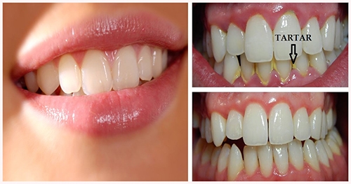 Dişleri Bu Yöntemle Beyazlatın ve Ağız Kokusunu Yok Edin galerisi resim 2