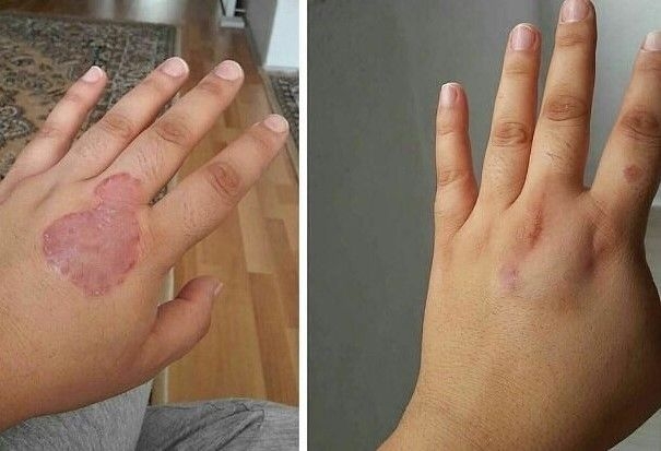 Travazol krem nedir ve nerelerde kullanılır galerisi resim 4