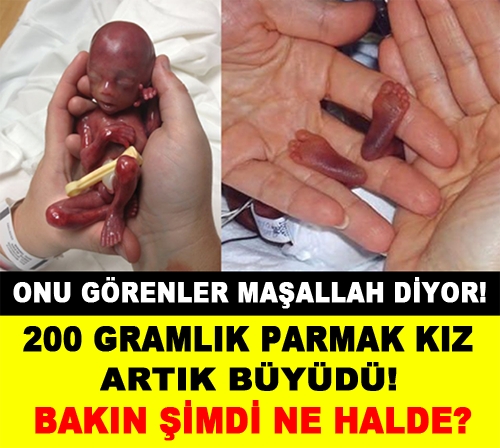 200 Gram Dünyaya gelmişti. Şimdi büyüdü bakın ne halde... galerisi resim 1